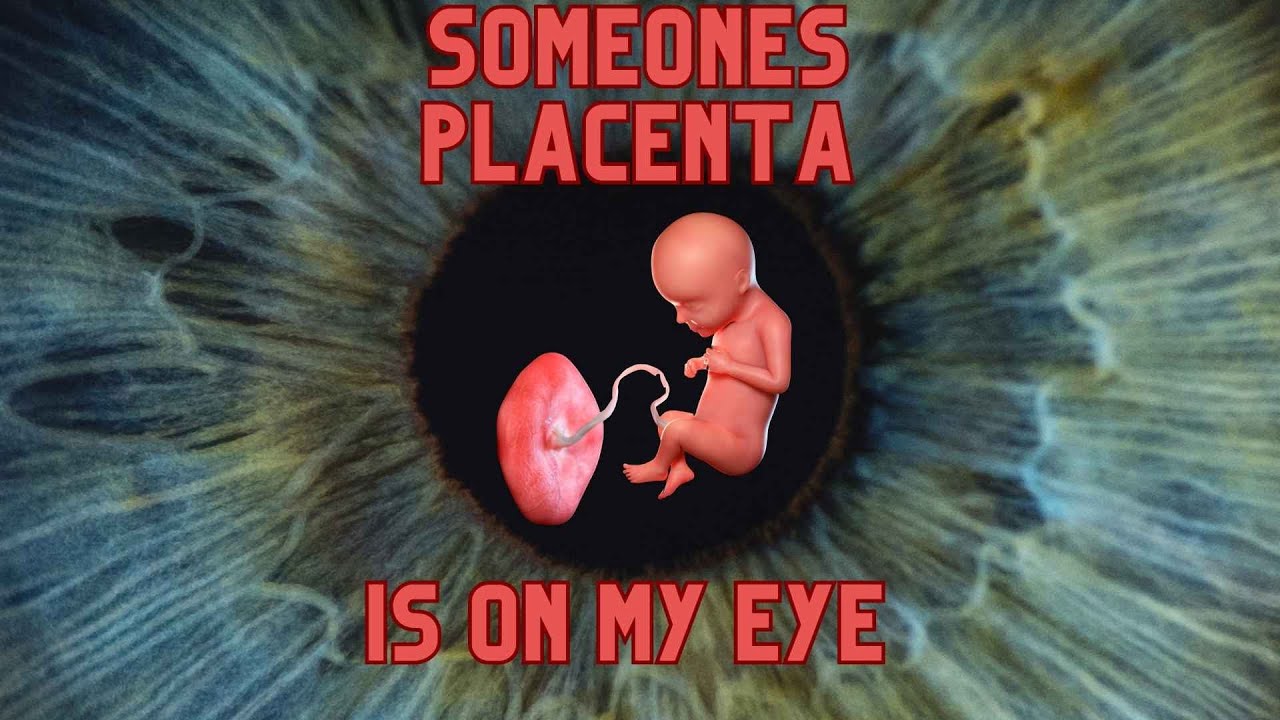 Someone s placenta is on my eye dr anthony maloof sydney youtube