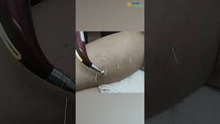 Calf Needling: Instant Relief for Tight &amp; Painful Calves! 🦵✨