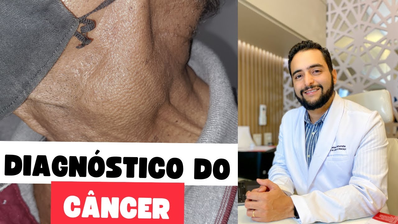 Câncer de tireoide, Câncer de laringe, sintomas do hipotireoidismo