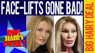 Facelifts Gone Bad