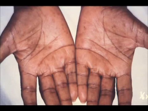 What is syphilis 70 What is syphilis 84