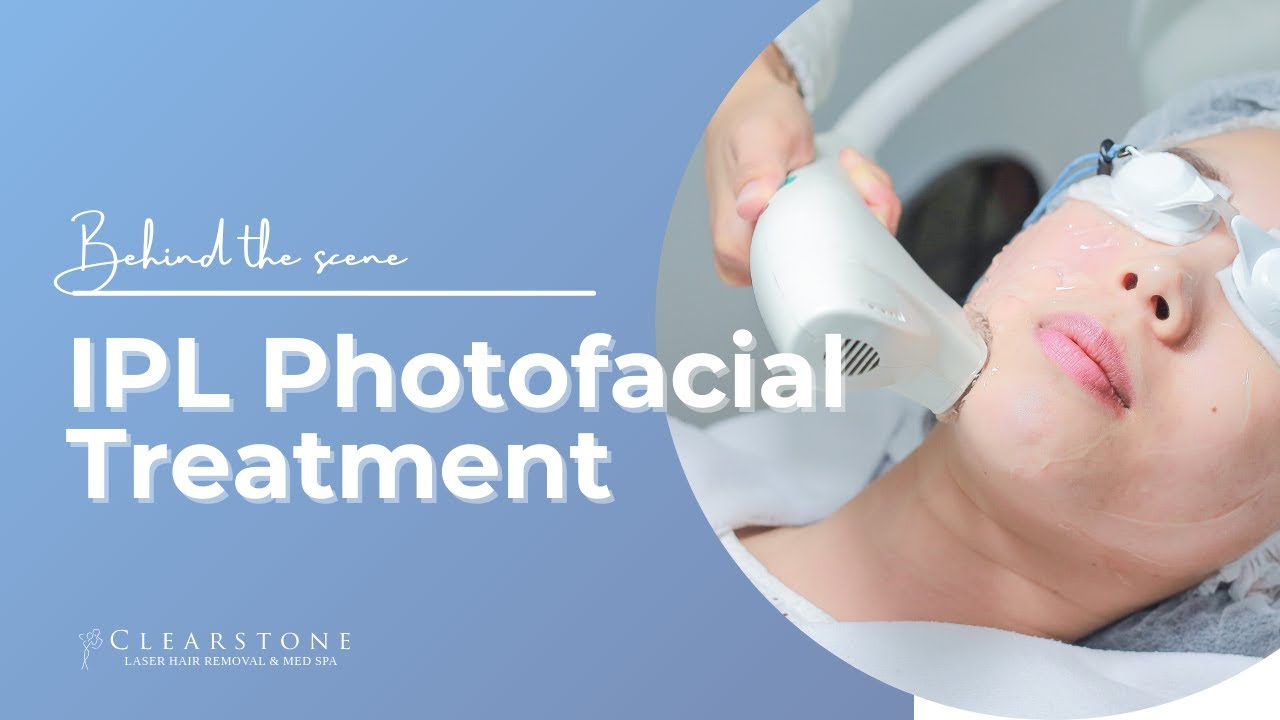 Clearstone IPL Photofacial Treatment YouTube