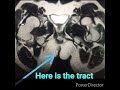 MR Fistulogram||how to do¿