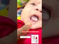 Baby stopped eating.Check tongue. Oral candidiasis. #candidiasis #baby #parentingtips #shorts #viral