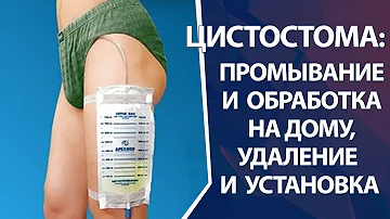Цистостома: замена и промывание цистостомы на дому и в клинике, установка и удаление цистостомы