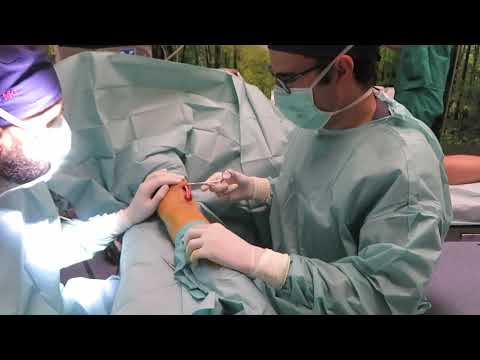 Triple uso del Ecógrafo en una cirugía miembro superior. Cirugia Ecoasistida , Sonosurgery Bernáldez