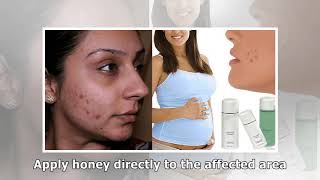 Pregnancy Acne 6 All-Natural Treatments