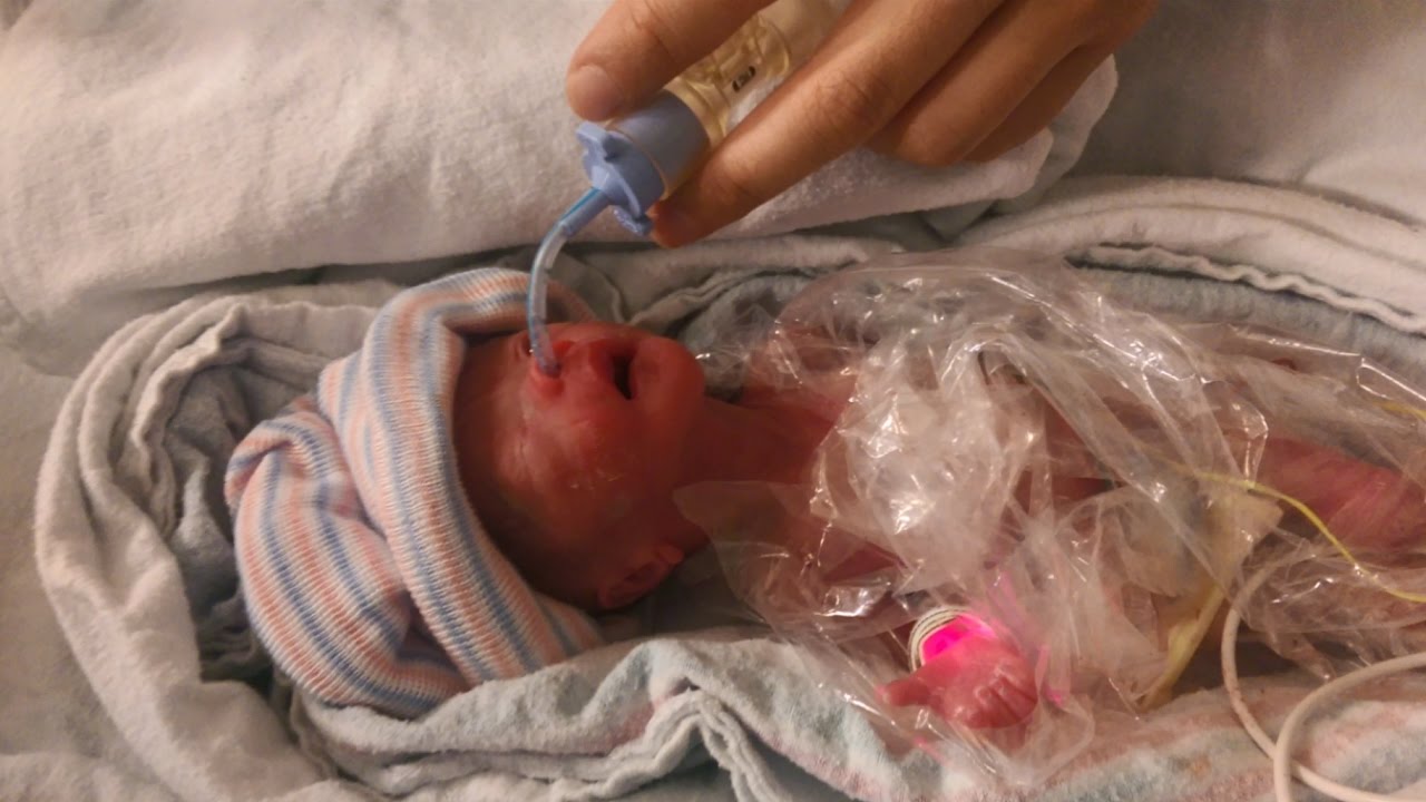 25 Week Micro Preemie 3 5 Months Premature Born At 1 Lb Happy 1st 25 Week Micro Preemie 3 5 Months Premature Born At 1 Lb Happy 1st