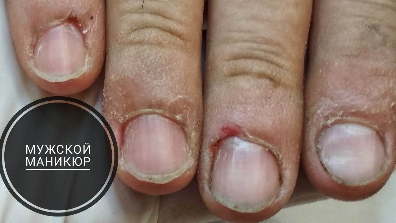ПАНАРИЦИЙ !!! НОГТИ В МЯСО / МУЖСКОЙ МАНИКЮР - YouTube
