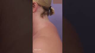 Say Goodbye to the Buffalo Hump with Liposuction
