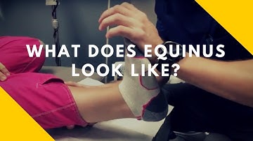 Difference Between Equinus Ankle and Normal Ankle
