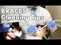 Cleaning Braces (Tips & Tricks for Dental Hygienists)