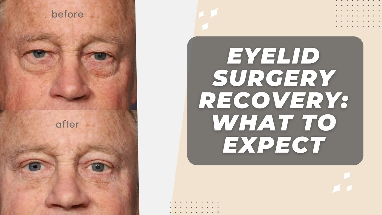 Eyelid Surgery Recovery: What To Expect