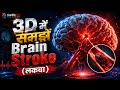 🧠 Brain Stroke (लकवा) का पूरा सच | 3D में समझिए | CardioNex Academy |