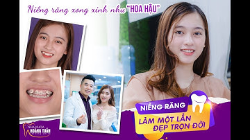 Cải thiện răng thưa - hô - móm sau niềng răng
