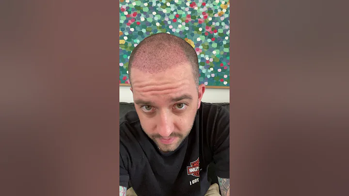 09 Marc, 33, 3 Weeks Post Hair Transplant