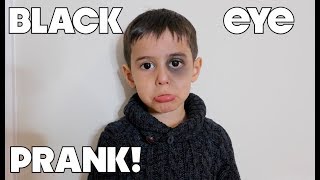 I Finally Pranked My Mom!! **Black Eye PRANK**