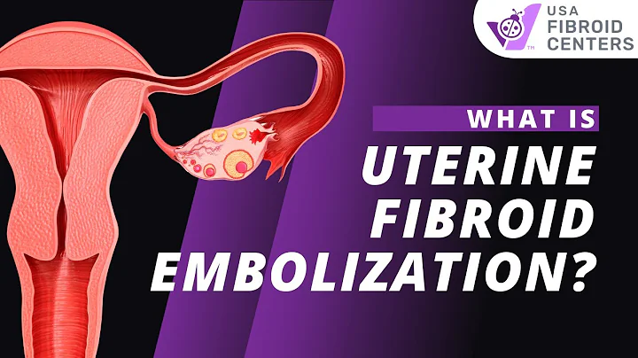 Watch How UFE (Uterine Fibroid Embolization) Works