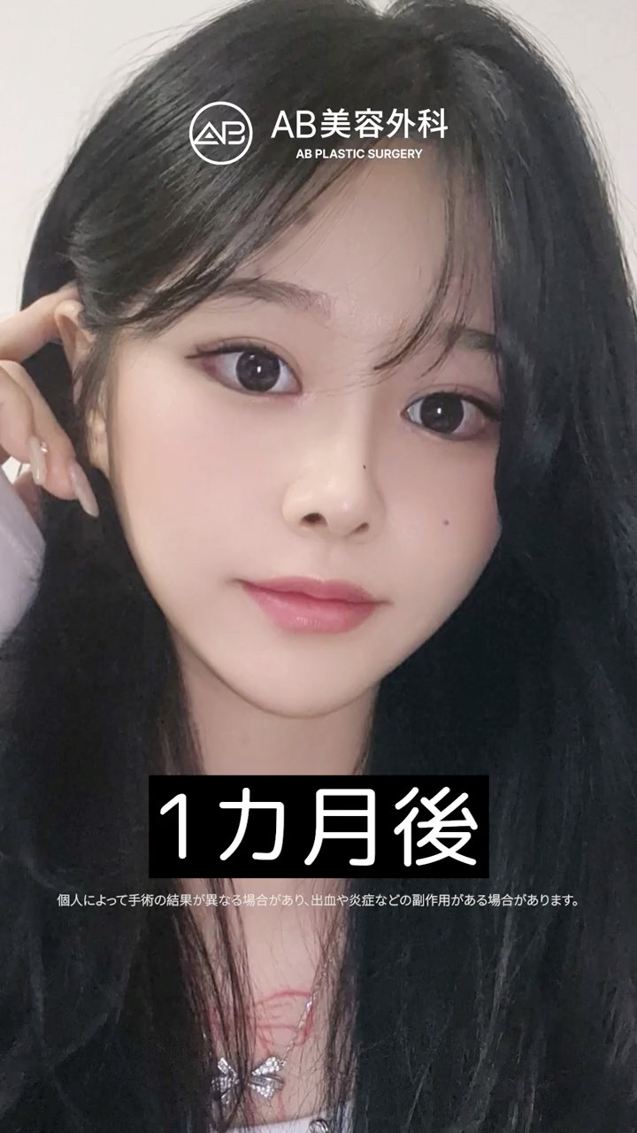 輪郭３点・目整形・鼻整形で理想の雰囲気に✨ #Shorts