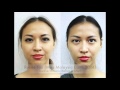 Botox Injection | Nexus Clinic