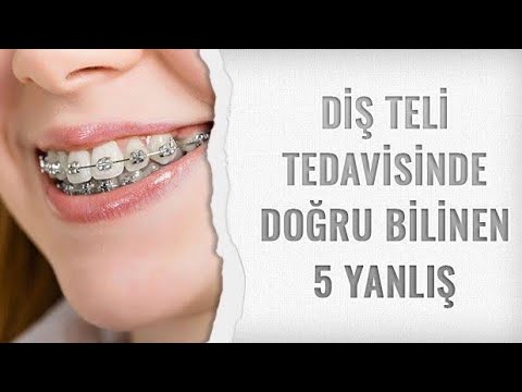 Diş Teli Takanlar Nelere Dikkat Etmeli / Diş Teli Tedavisi / Diş Teli Faydalımı