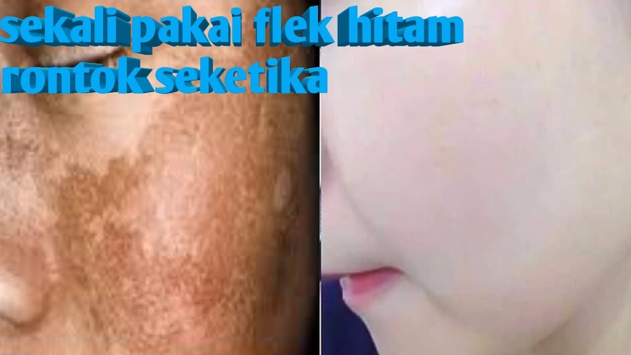 Cara menghilangkan flek hitam dengan bahan alami 