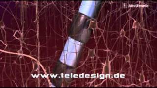 Gn 103 Nervenstimulation Bei Parkinson - Pal 169 Gn 103 Deep Brain Stimulation - Pal 169