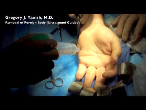 Hand Foreign Body Removal - Ultrasound Guided
