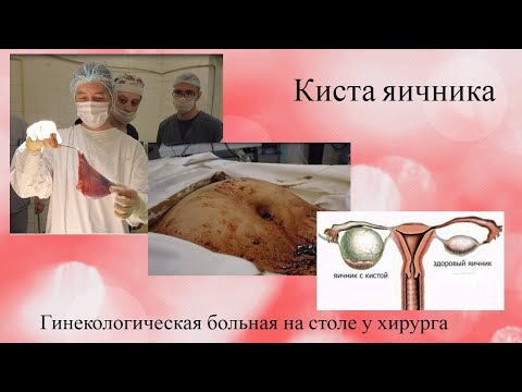 киста яичника. Гинекологическая больная на столе у хирурга