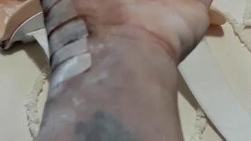 Almost 3 weeks post-op Trapeziectomy with tendon from my arm