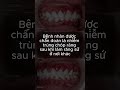 Chăm sóc viêm nướu sau bọc răng sứ 🦷