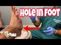 ANOTHER DIABETIC FOOT CATASTROPHE AND BONUS DIABETIC FOOT CARE TIPS