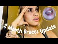 2 Month Braces Update | I hate the results so far 😣