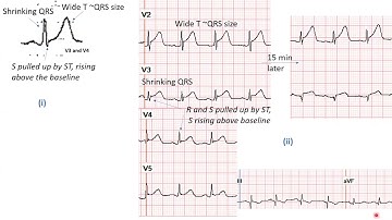 Occlusion MI (OMI): ECG patterns and cases