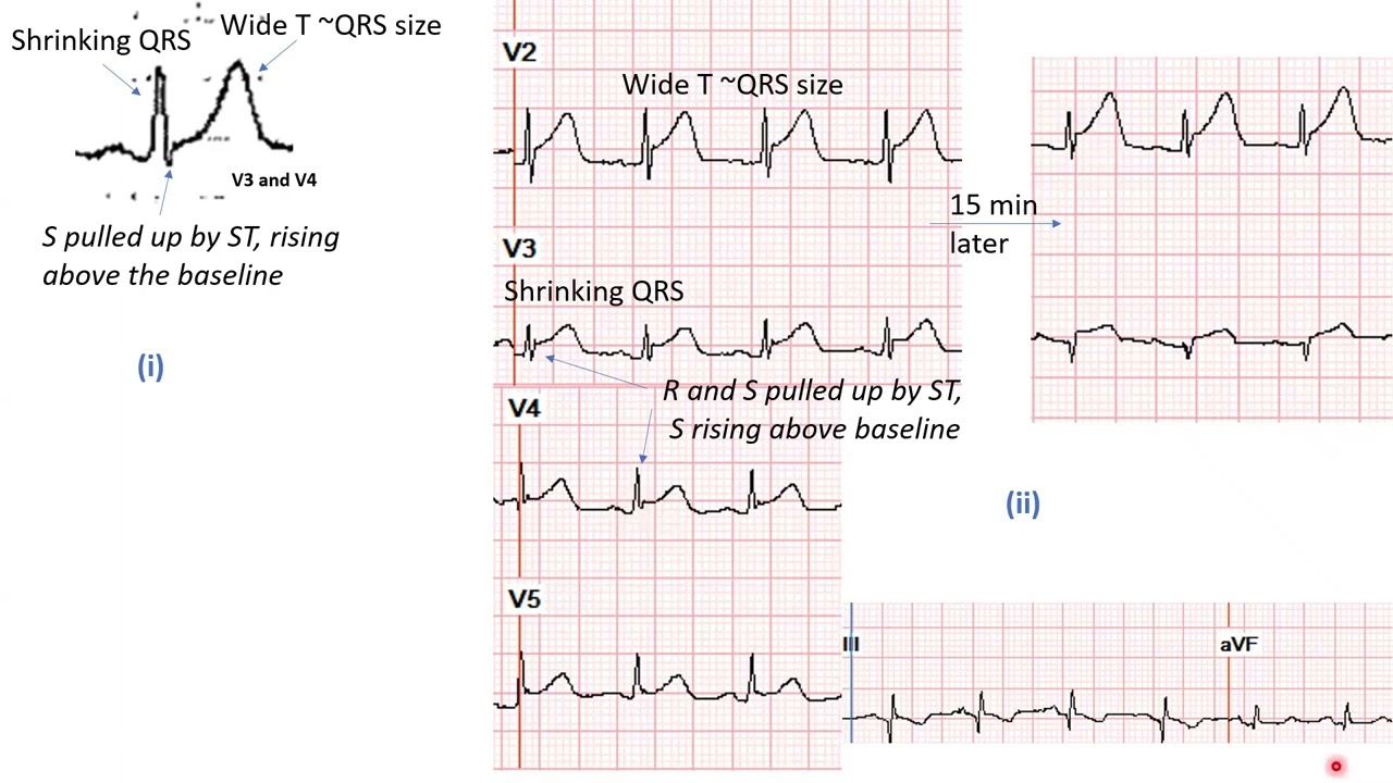 Occlusion MI (OMI): ECG patterns and cases