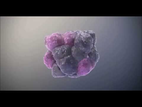 Video: Cystic Fibrosis: Oorzaken, Diagnose En Behandeling