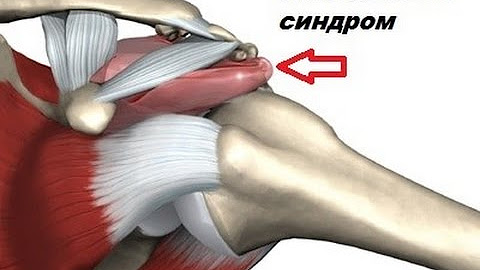 Субакромиального пространства плечевого сустава. Импиджмент синдром плеча. Субакромиальный импинджмент. Подакромиальный импиджмент синдром. Импиджмент синдром плечевого сустава.