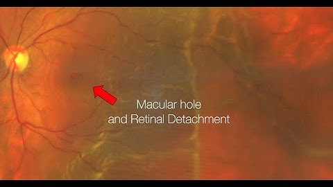 Vitrectomy for Macular hole and Retinal Detachment | Tijuana, Mexico