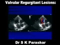 A , Valvular Regurgitant Lesions  Dr S K Parashar