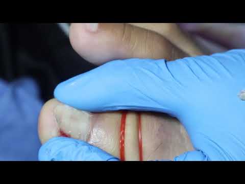 Ep_3242 Foot nails skin removal 👣 พี่ขอเวลานอกก่อน 😷 (This clip is from Thailand)