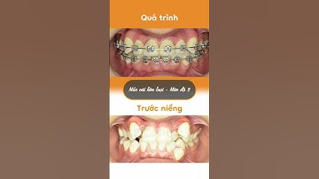Hành trình LỘT XÁC nhờ niềng răng của Nguyễn Hường