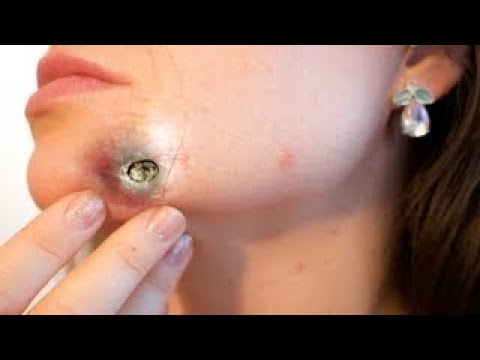 blackhead popping 2021