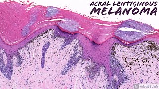 Acral Lentiginous Melanoma Dermatopathology