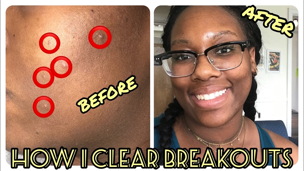 my current spring/summer skincare routine | how i clear my breakouts ...