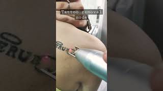 Tattoo Removing With Laser