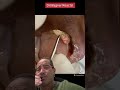 Extraction of enormous ingrown toenailshorts