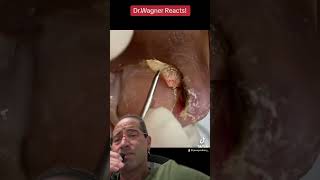 EXTRACTION OF ENORMOUS INGROWN TOENAIL#shorts