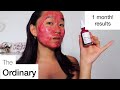 The Ordinary AHA 30% + BHA 2% Peeling Solution    // HONEST review, 1 MONTH, REAL results