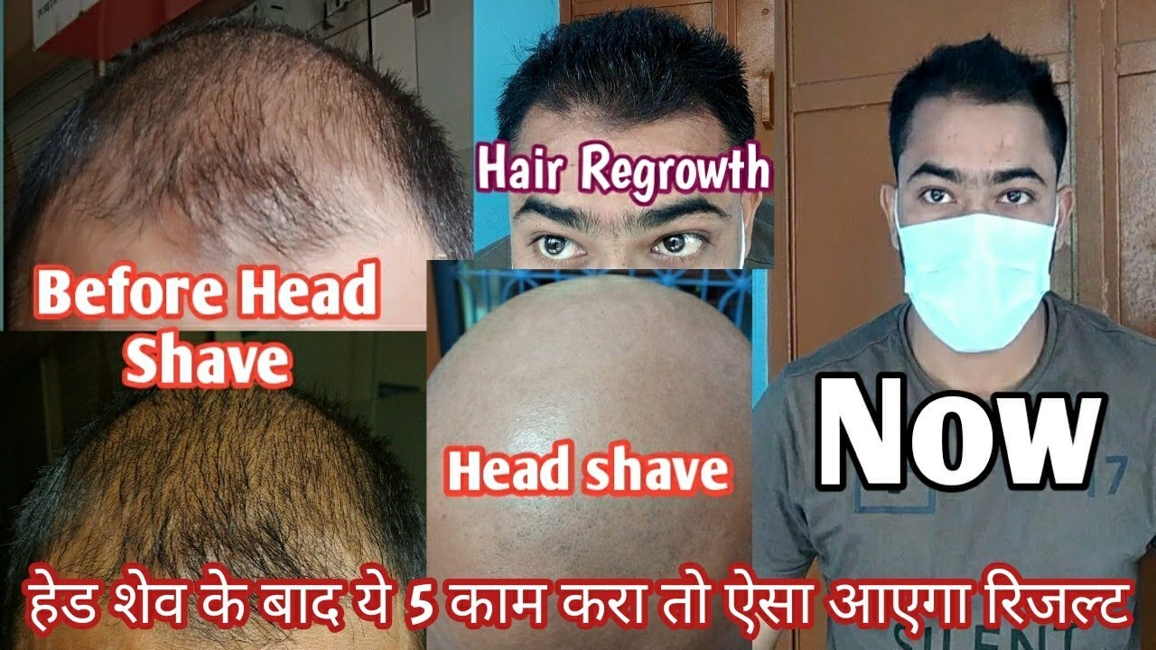 Head Shave ke baad ye 5 cheez kra to New Hairs aaenge 100 Hair fall