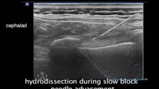 Intercostal Nerve Block